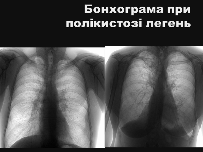 Бонхограма при полікистозі легень